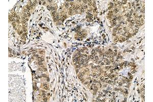ABIN7095525 and ABIN7099582 at 1/100 staining human lung cancer and adjacent non-tumor tissue by IHC-P.
