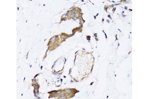 Immunohistochemistry of paraffin-embedded Human breast cancer using NAA10 Polyclonal Antibody at dilution of 1:100 (40x lens).