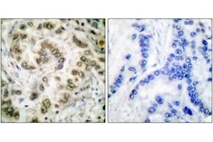 Immunohistochemistry analysis of paraffin-embedded human lung carcinoma tissue, using E2F4 Antibody. (E2F4 Antikörper  (AA 51-100))