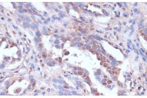 Immunohistochemistry of paraffin-embedded Human lung cancer using CARTPT Polyclonal Antibody at dilution of 1:100 (40x lens). (CARTPT Antikörper)