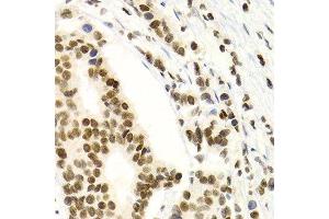 Immunohistochemistry of paraffin-embedded human breast cancer using NFKB2 Antibody.