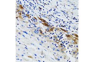 Immunohistochemistry of paraffin-embedded human liver cancer using USO1 antibody (ABIN1875291) at dilution of 1:100 (40x lens). (USO1 Antikörper)