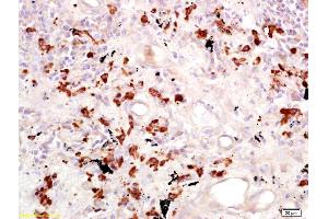 Formalin-fixed and paraffin embedded human lung carcinoma labeled with Anti-CD15/Fut4/SSEA-1 Polyclonal Antibody, Unconjugated (ABIN733193) at 1:200 followed by conjugation to the secondary antibody and DAB staining.