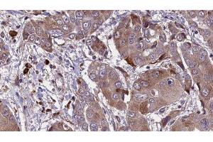 ABIN6276579 at 1/100 staining Human liver cancer tissue by IHC-P. (KCNE1 Antikörper  (Internal Region))