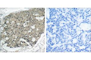 Peptide - +Immunohistochemical analysis of paraffin-embedded human breast carcinoma tissue using Akt (Ab-308) antibody (#B7005). (AKT1 Antikörper  (Thr308))