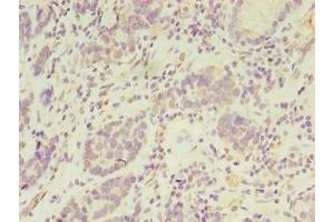 Immunohistochemistry of paraffin-embedded human gastric cancer using ABIN7169047 at dilution of 1:100 (PSKH2 Antikörper  (AA 63-320))