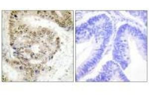 Immunohistochemistry analysis of paraffin-embedded human colon carcinoma tissue using hnRNP L antibody. (HNRNPL Antikörper  (N-Term))