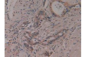 IHC-P analysis of Human Pancreas Cancer Tissue, with DAB staining. (PTGDS Antikörper  (AA 32-190))