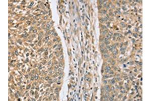 The image on the left is immunohistochemistry of paraffin-embedded Human lung cancer tissue using ABIN7130828(RASSF4 Antibody) at dilution 1/25, on the right is treated with fusion protein. (RASSF4 Antikörper)