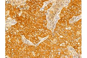 ABIN6265403 and ABIN6273018 at 1/100 staining Human lung cancer by IHC-P. (Syntaxin 11 Antikörper  (Internal Region))