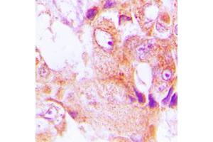 Immunohistochemical analysis of ABHD9 staining in human lung cancer formalin fixed paraffin embedded tissue section. (ABHD9 Antikörper  (Center))