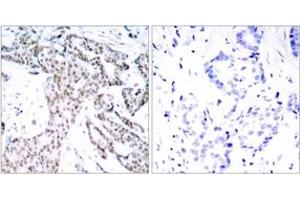 Immunohistochemistry analysis of paraffin-embedded human breast carcinoma, using STAT3 (Phospho-Ser727) Antibody. (STAT3 Antikörper  (pSer727))