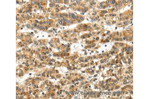 Immunohistochemistry of Human thyroid cancer using PAPPA Polyclonal Antibody at dilution of 1:50 (PAPPA Antikörper)