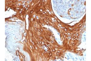 Formalin-fixed, paraffin-embedded human Basal Cell Carcinoma stained with Cytokeratin 6A (KRT6A) Mouse Monoclonal Antibody (KRT6A/2368). (KRT6A Antikörper)