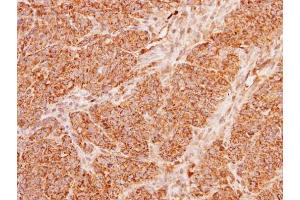 IHC-P Image Immunohistochemical analysis of paraffin-embedded DLD1 xenograft, using ACADM, antibody at 1:100 dilution. (Medium-Chain Specific Acyl-CoA Dehydrogenase, Mitochondrial (N-Term) Antikörper)