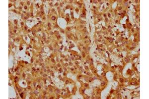 IHC image of ABIN7169288 diluted at 1:200 and staining in paraffin-embedded human liver cancer performed on a Leica BondTM system.