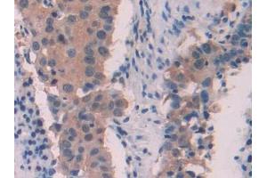 DAB staining on IHC-P; Samples: Human Lung cancer Tissue (MYL6 Antikörper  (AA 4-146))
