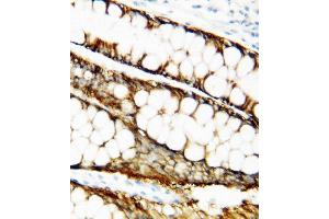 Anti-TIMP1 antibody, IHC(P) IHC(P): Human Mammary Cancer Tissue