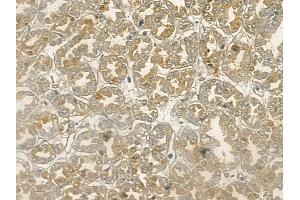 ABIN6255618 and ABIN6267141 at 1/100 staining human renal cell carcinoma by IHC-P. (MST1 Antikörper  (pThr183))