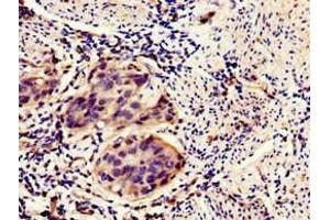 Immunohistochemistry of paraffin-embedded human bladder cancer using ABIN7155869 at dilution of 1:100 (HIPK3 Antikörper  (AA 841-1130))