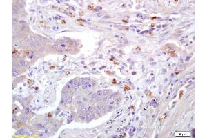 Formalin-fixed and paraffin embedded human lung carcinoma labeled with Anti-Caveolin-1 Polyclonal Antibody, Unconjugated (ABIN686752) at 1:200 followed by conjugation to the secondary antibody and DAB staining. (Caveolin-1 Antikörper  (AA 2-120))