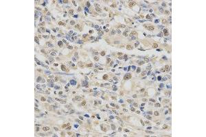 Immunohistochemistry of paraffin-embedded human stomach cancer using SPHK1 antibody at dilution of 1:200 (x400 lens). (SPHK1 Antikörper  (AA 50-384))