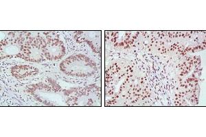 Immunohistochemical analysis of paraffin-embedded human rectum cancer (left) and ovarian cancer (right) tissues, showing nuclear localization with DAB staining using MLH1 mouse mAb. (MLH1 Antikörper  (AA 381-483))