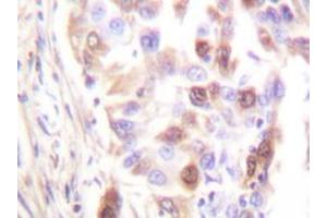 Immunohistochemistry analyzes of RFA2 antibody in paraffin-embedded human lung carcinoma tissue. (RPA2 Antikörper  (AA 115-129))