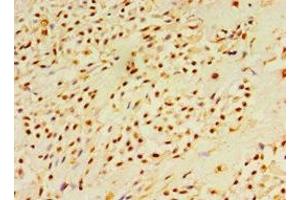 Immunohistochemistry of paraffin-embedded human breast cancer using ABIN7150785 at dilution of 1:100 (DUSP7 Antikörper  (AA 160-419))