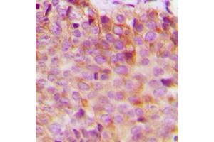 Immunohistochemical analysis of 14-3-3 eta staining in human breast cancer formalin fixed paraffin embedded tissue section. (14-3-3 eta Antikörper  (Center))