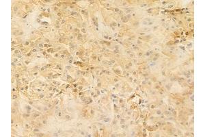 ABIN6255637 and ABIN6267229 at 1/100 staining human renal cell carcinoma by IHC-P. (IKK alpha Antikörper  (pThr23))