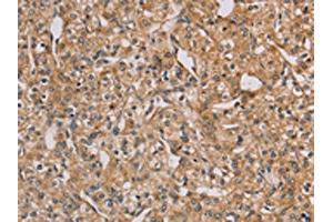 The image on the left is immunohistochemistry of paraffin-embedded Human prostate cancer tissue using ABIN7128941(CHRNA4 Antibody) at dilution 1/20, on the right is treated with fusion protein. (CHRNA4 Antikörper)