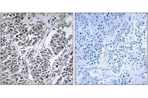 Immunohistochemistry analysis of paraffin-embedded human lung carcinoma tissue, using ATP5D Antibody. (ATP5F1D Antikörper  (AA 61-110))