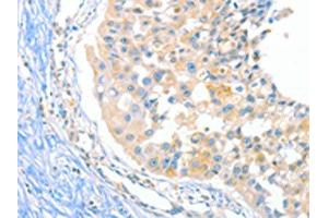 The image on the left is immunohistochemistry of paraffin-embedded Human breast cancer tissue using ABIN7129275(DUSP14 Antibody) at dilution 1/20, on the right is treated with fusion protein. (DUSP14 Antikörper)