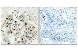 Immunohistochemistry analysis of paraffin-embedded human breast carcinoma tissue, using AF4 antibody. (AF4 Antikörper  (N-Term))
