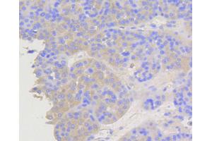 Immunohistochemistry of paraffin-embedded human liver cancer using ARRB1 antibody (ABIN5996907) at dilution of 1/100 (40x lens). (beta Arrestin 1 Antikörper)