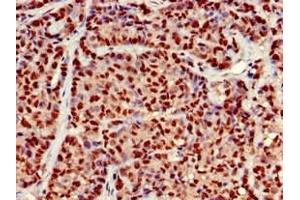 Immunohistochemistry of paraffin-embedded human ovarian cancer using ABIN7164525 at dilution of 1:100 (EARS2 Antikörper  (AA 42-166))