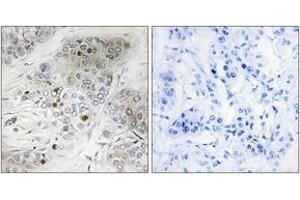 Immunohistochemistry analysis of paraffin-embedded human breast carcinoma, using p53 (Phospho-Ser9) Antibody. (p53 Antikörper  (pSer9))