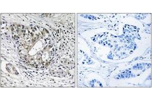 Immunohistochemistry analysis of paraffin-embedded human breast carcinoma tissue, using PNPT1 Antibody.