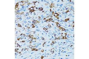 Immunohistochemistry of paraffin-embedded human uterine cancer using CTSE antibody (ABIN5971444) at dilution of 1/100 (40x lens). (Cathepsin E Antikörper)