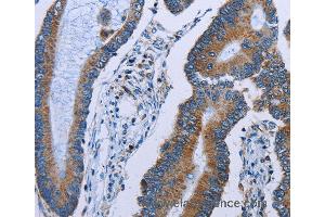 Immunohistochemistry of Human colon cancer using IDH2 Polyclonal Antibody at dilution of 1:60 (IDH2 Antikörper)