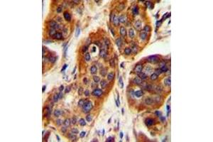 Immunohistochemistry analysis in formalin fixed and paraffin embedded human bladder carcinoma reacted with LRRC57 Antibody (C-term) followed which was peroxidase conjugated to the secondary antibody and followed by DAB staining. (LRRC57 Antikörper  (C-Term))
