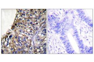 Immunohistochemical analysis of paraffin-embedded human lung carcinoma tissue using Claudin 7 antibody (ABIN5976363). (Claudin 7 Antikörper  (C-Term))