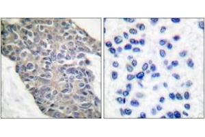 Immunohistochemistry analysis of paraffin-embedded human breast carcinoma tissue, using Synaptotagmin (Ab-202) Antibody. (Synaptotagmin Antikörper  (AA 176-225))