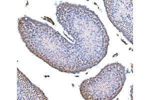 IHC analysis of Survivin using anti-Survivin antibody (ABIN3043511).
