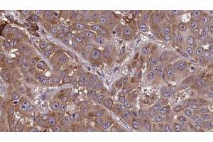 ABIN6273449 at 1/100 staining Human liver cancer tissue by IHC-P. (CD48 Antikörper  (Internal Region))