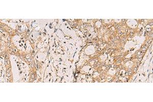 Immunohistochemistry of paraffin-embedded Human cervical cancer tissue using FYCO1 Polyclonal Antibody at dilution of 1:110(x200)
