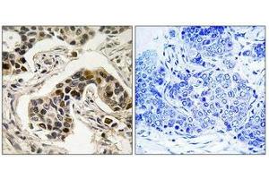 Immunohistochemistry analysis of paraffin-embedded human breast carcinoma tissue using NudC (Phospho-Ser326) antibody.