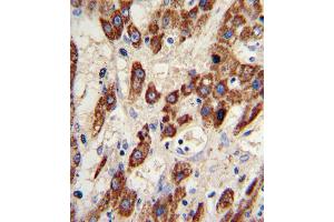 Formalin-fixed and paraffin-embedded human hepatocarcinoma reacted with MMP3 Antibody , which was peroxidase-conjugated to the secondary antibody, followed by DAB staining. (MMP3 Antikörper  (AA 298-327))