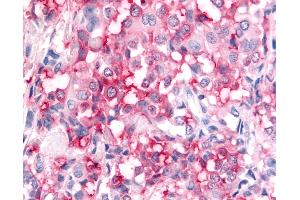 Anti-ADAMTS5 antibody IHC of human Breast, Carcinoma. (ADAMTS5 Antikörper  (Metalloprotease Domain))